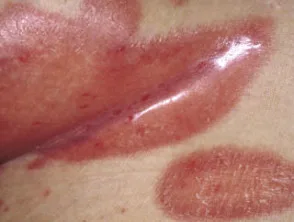 Biegepsoriasis