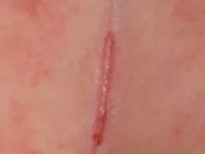 Biegepsoriasis