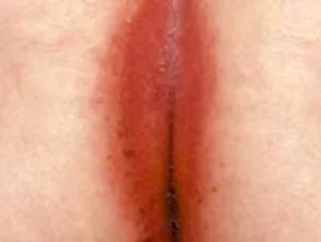 Biegepsoriasis