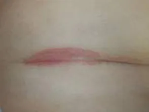 Biegepsoriasis