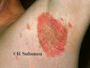 Biegepsoriasis