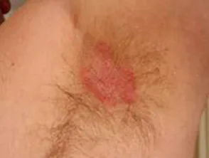 Biegepsoriasis