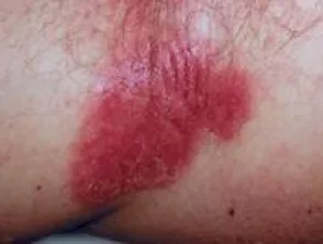 Biegepsoriasis