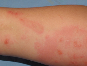 Dermatitis por contacto con plantas