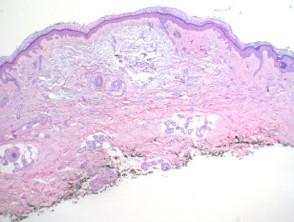 Mucinosis focal figure1