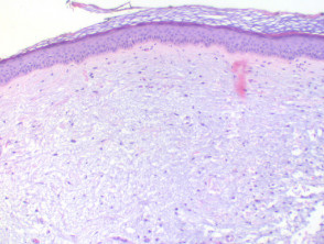 Mucinosis focal figure3