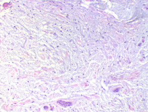 Mucinosis focal figure4