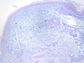 Mucinosis focal figure5