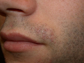 Foliculitis de la barba