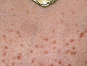 Follikulitis