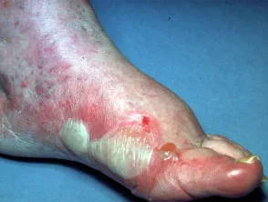 Fußdermatitis