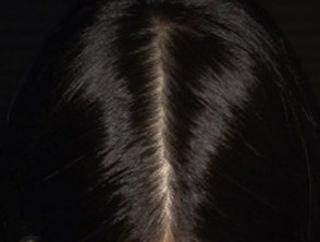 Pérdida de cabello de patrón femenino