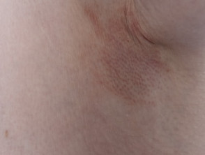 Dermatitis alérgica de contacto a las fragancias.