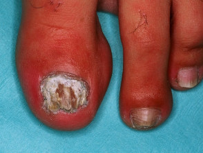 Infección por fusarium de la uña del pie