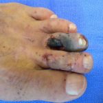 gangrene-1__protectwyjqcm90zwn0il0_focusfillwzi5ncwymjisingildfd-6322372-2877110-jpg-9412113