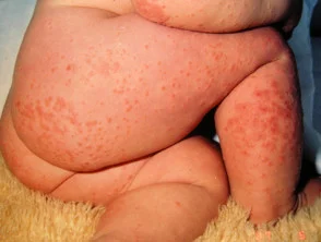 Infantiele papulaire acrodermatitis