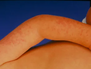 Infantiele papulaire acrodermatitis