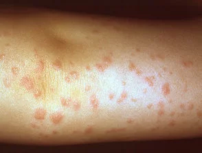 Infantiele papulaire acrodermatitis