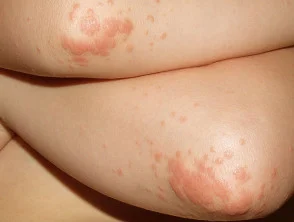 Infantiele papulaire acrodermatitis