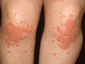 Infantiele papulaire acrodermatitis