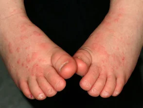 Infantiele papulaire acrodermatitis