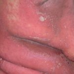 gen-pustular-psoriasis-01__protectwyjqcm90zwn0il0_focusfillwzi5ncwymjisinkildg1xq-5562368-1440435-jpg-5414975