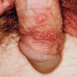 genital-herpes-s__protectwyjqcm90zwn0il0_focusfillwzi5ncwymjisingildfd-9746861-4601502-jpg-2879941