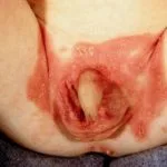 genital-psoriasis-01__protectwyjqcm90zwn0il0_focusfillwzi5ncwymjisingildfd-9054210-6199161-jpg-4649828