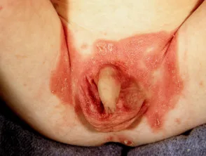 genitale psoriasis