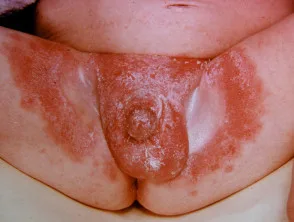 genitale psoriasis