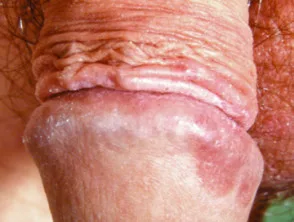 genitale psoriasis