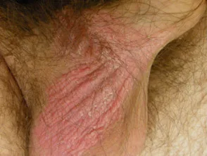 genitale psoriasis