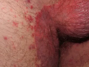 genitale psoriasis