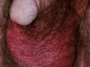 genitale psoriasis