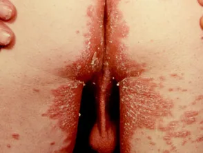 genitale psoriasis