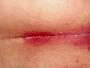 genitale psoriasis