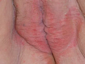 genitale psoriasis