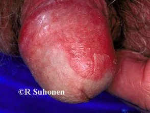 genitale psoriasis