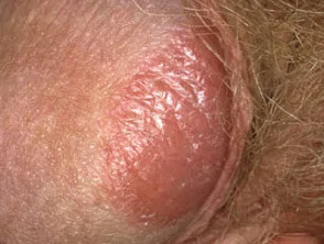 genitale psoriasis