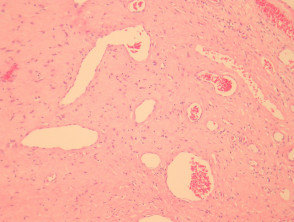 giant-cell-fibroblastoma-fig-1__protectwyjqcm90zwn0il0_focusfillwzi5ncwymjisingildfd-4227252-4770030-jpg-7655468