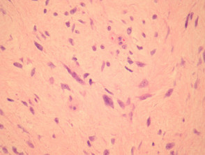 Patología del fibroblastoma de células gigantes