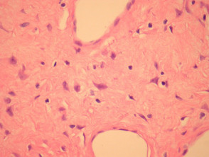 Patología del fibroblastoma de células gigantes