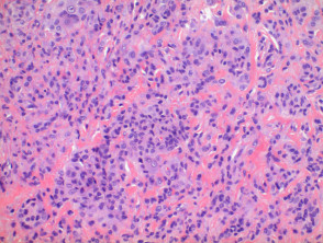 Tumor de células gigantes de patología de la vaina del tendón