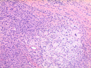 Tumor de células gigantes de patología de la vaina del tendón
