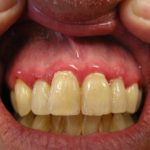 gingivitis-01__protectwyjqcm90zwn0il0_focusfillwzi5ncwymjisingildfd-7528959-4870939-jpg-5190847