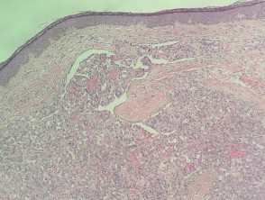 Patología del hemangioma glomeruloide