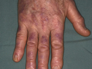 Dermatomiositis por pápulas de Gottron