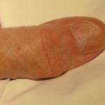 gout4__protectwyjqcm90zwn0il0_focusfillwzi5ncwymjisingildfd-9410398-6031983-jpg-9325266