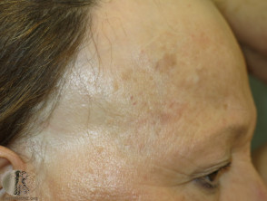 Síndrome de Graham Little.  Alopecia cicatricial del cuero cabelludo anterior