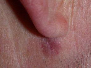 Granuloma facial